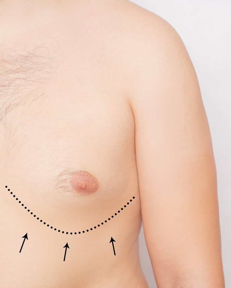 Leczenie Ginekomastii Katowice